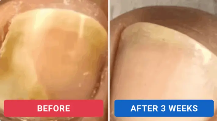 Oroville Nail Fungus Pen customer review Jason